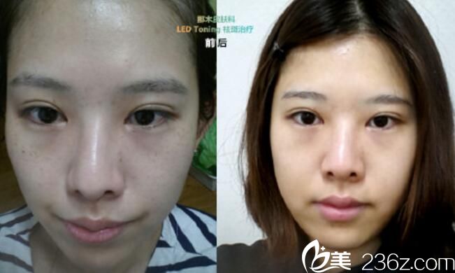 徐光奭 院長 皮膚治療案例 徐光奭 院長 皮膚治療案例