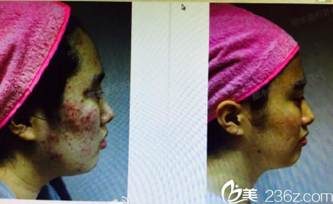 徐光奭 皮膚治療案例 徐光奭 皮膚治療案例