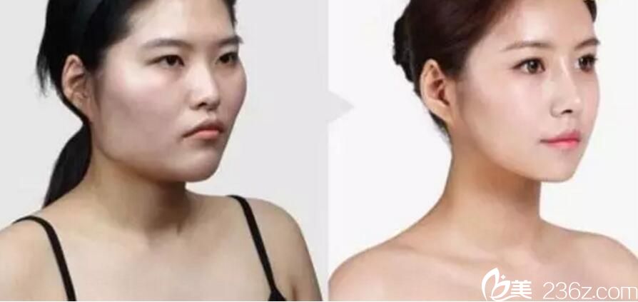 金洞河輪廓手術(shù)案例 金洞河輪廓手術(shù)案例