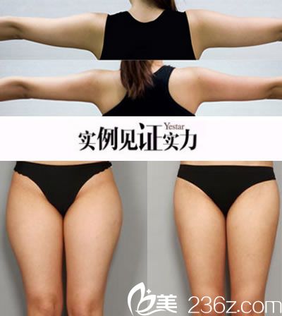 溫州藝星黃樂(lè)做吸脂真人效果