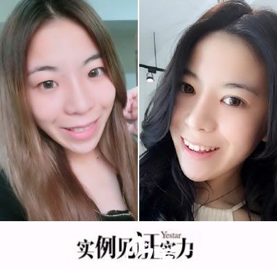 溫州藝星黃樂(lè)切開(kāi)雙眼皮真人效果
