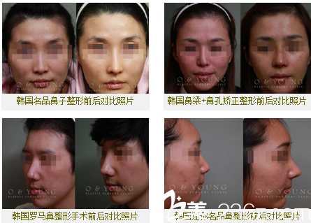 韓國O&YOUNG整形外科案例 韓國O&YOUNG整形外科案例