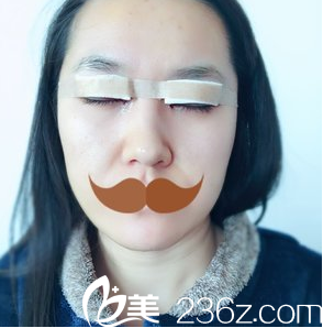 安徽韓美整形閆品行切開(kāi)雙眼皮術(shù)后1天 安徽韓美整形閆品行切開(kāi)雙眼皮術(shù)后1天