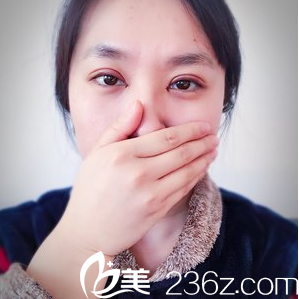 安徽韓美切開(kāi)雙眼皮+開(kāi)內(nèi)眼角術(shù)后2天效果 安徽韓美切開(kāi)雙眼皮+開(kāi)內(nèi)眼角術(shù)后2天效果