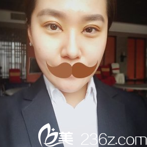 安徽韓美整形雙眼皮手術(shù)第四天恢復(fù)情況 安徽韓美整形雙眼皮手術(shù)第四天恢復(fù)情況