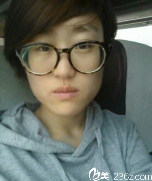 那木整形醫(yī)院多元化下頜角整形案例