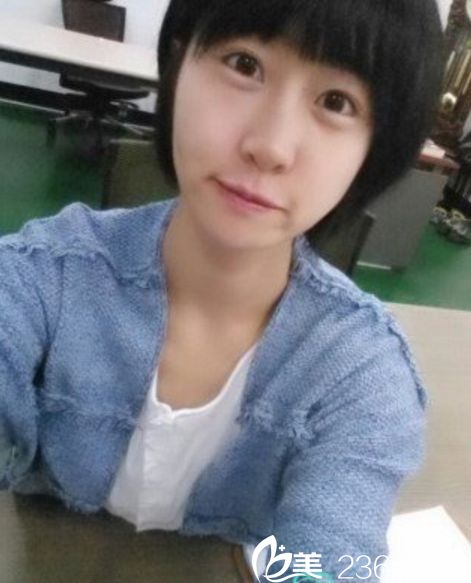 那木整形醫(yī)院多元化下頜角、下巴手術(shù)、貴族手術(shù)、Real鼻整形、脂肪填充真人案例