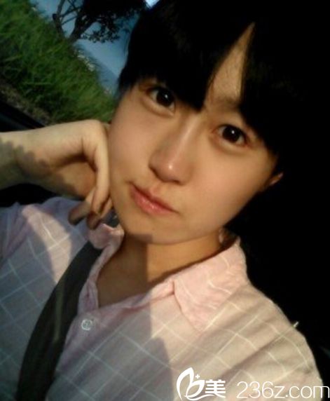 那木自體脂肪填充案例