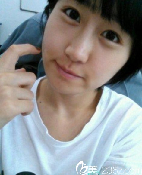 那木下巴手術(shù)案例