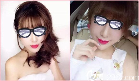 南陽艾美水光注射案例 南陽艾美水光注射案例