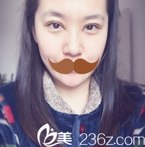 閆品行切開(kāi)雙眼皮術(shù)后3天恢復(fù)情況 閆品行切開(kāi)雙眼皮術(shù)后3天恢復(fù)情況