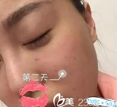 南陽艾美水光注射第二天 南陽艾美水光注射第二天