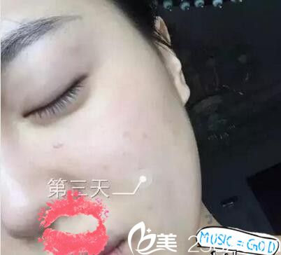 南陽艾美水光注射第三天 南陽艾美水光注射第三天