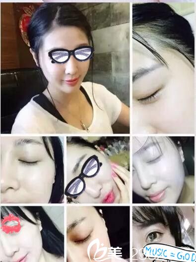 南陽艾美水光注射第七天 南陽艾美水光注射第七天