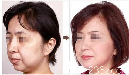 韓國O&YOUNG整形外科案例 韓國O&YOUNG整形外科案例