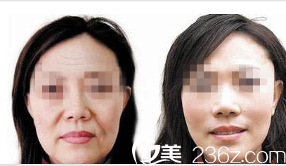 韓國O&YOUNG整形外科案例 韓國O&YOUNG整形外科案例