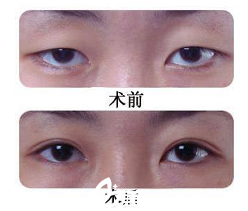 韓國O&YOUNG整形外科案例 韓國O&YOUNG整形外科案例