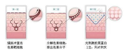 韓國奧拉克皮膚科整外科激光美白圖 韓國奧拉克皮膚科整外科激光美白圖