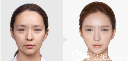 韓國O&YOUNG整形外科案例