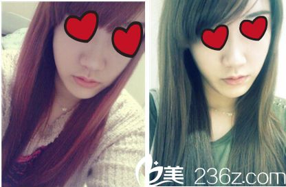 鼻整形+脂肪移植手術(shù)對比 鼻整形+脂肪移植手術(shù)對比