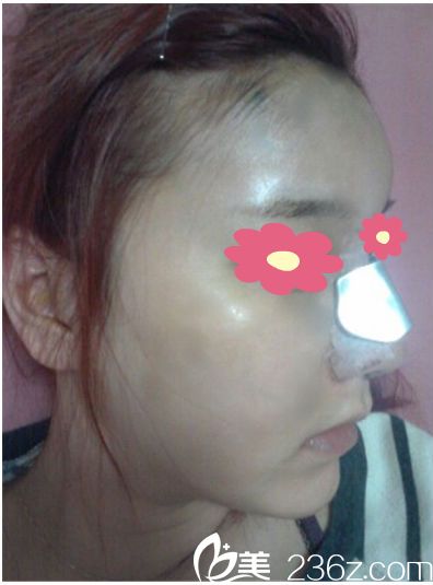 鼻整形+脂肪移植手術(shù)兩天 鼻整形+脂肪移植手術(shù)兩天