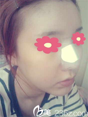 鼻整形+脂肪移植手術(shù)三天 鼻整形+脂肪移植手術(shù)三天