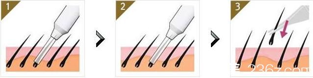 韓國奧拉克皮膚科整外科毛發(fā)移植 韓國奧拉克皮膚科整外科毛發(fā)移植