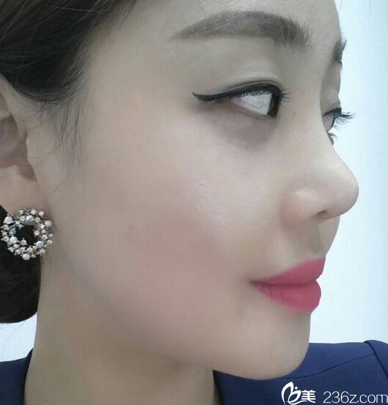 金正培隆鼻<span style= 金正培隆鼻<span style=