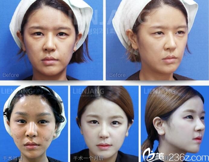 金正培 面部提升 金正培 面部提升