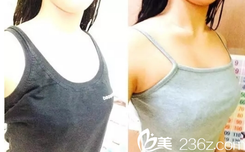 韓國jk整形外科醫(yī)院做隆胸手術(shù)真人案例 韓國jk整形外科醫(yī)院做隆胸手術(shù)真人案例