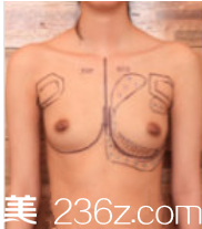 韓國棒棒（BONGBONG）整形外科案例