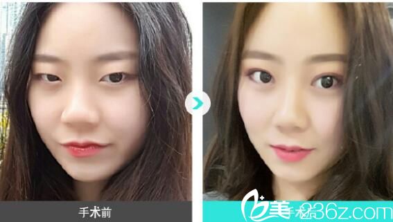 金志桓雙眼皮案例 金志桓雙眼皮案例