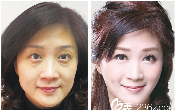 廣州健麗醫(yī)美曹寶濟(jì)祛眼袋案例 廣州健麗醫(yī)美曹寶濟(jì)祛眼袋案例