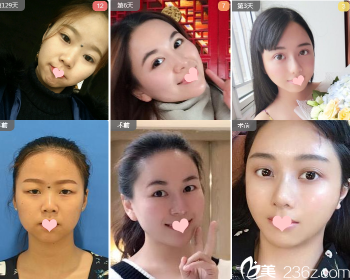 廣州健麗醫(yī)美曹寶濟(jì)雙眼皮案例 廣州健麗醫(yī)美曹寶濟(jì)雙眼皮案例