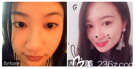 廣州健麗醫(yī)療美容張晨光雙眼皮案例 廣州健麗醫(yī)療美容張晨光雙眼皮案例