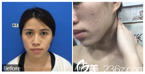 廣州健麗醫(yī)療美容張晨光皮膚美容案例 廣州健麗醫(yī)療美容張晨光皮膚美容案例