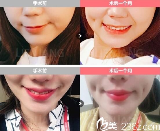 鄭賢煜酒窩成形術(shù)案例 鄭賢煜酒窩成形術(shù)案例