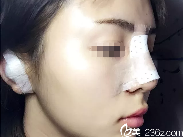 鼻綜合手術(shù)當(dāng)天