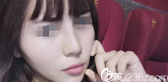 魏亨坤院長(zhǎng)鼻綜合術(shù)后一個(gè)月