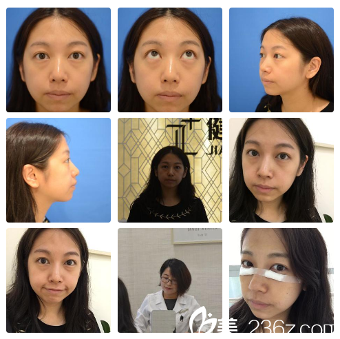 祛眼袋術(shù)前照片 祛眼袋術(shù)前照片