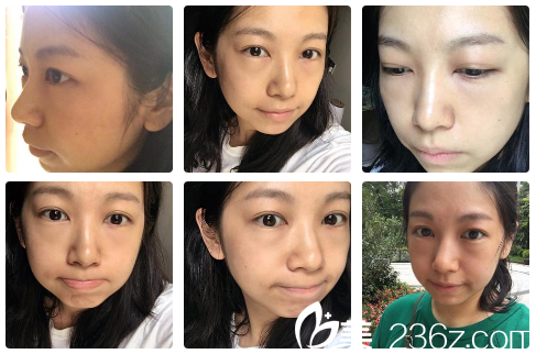 在廣州健麗醫(yī)美做完祛眼袋第二天生活照 在廣州健麗醫(yī)美做完祛眼袋第二天生活照