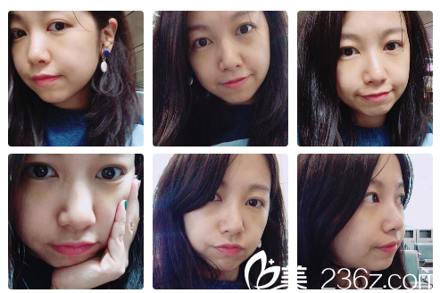 找曹寶濟(jì)院長(zhǎng)做完祛眼袋4天了 找曹寶濟(jì)院長(zhǎng)做完祛眼袋4天了