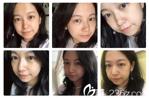 曹寶濟(jì)院長(zhǎng)祛眼袋7天<span style= 曹寶濟(jì)院長(zhǎng)祛眼袋7天<span style=