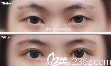 韓國MVP整形外科醫(yī)院案例