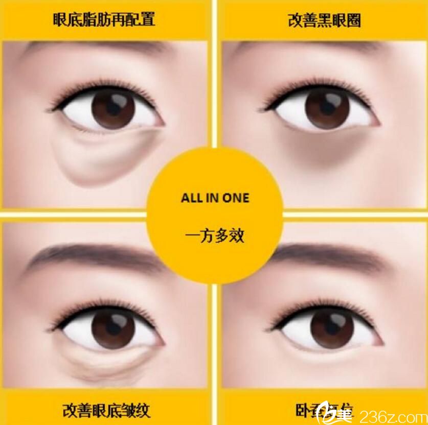 眼底脂肪再配置- 輕松無痕祛除眼袋