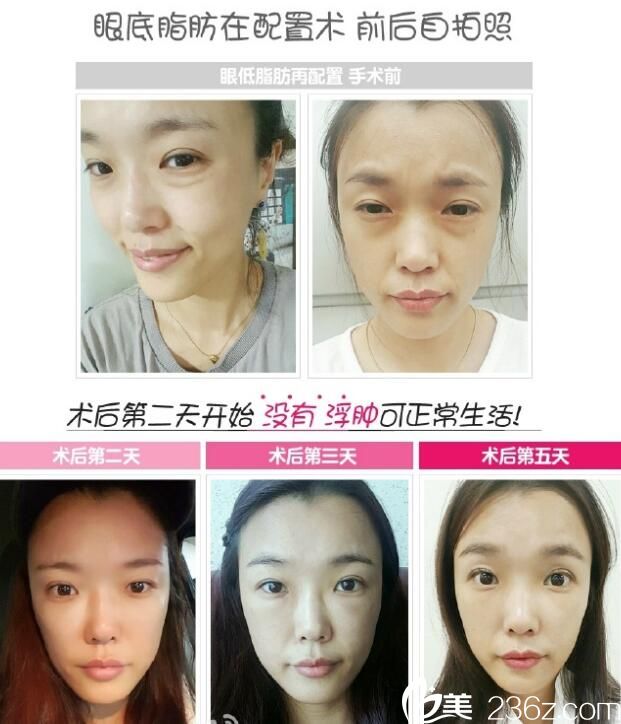 張榮佑眼底脂肪再配置術(shù)案例