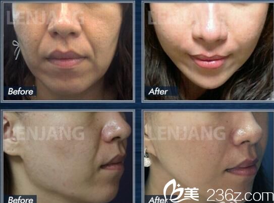 張榮佑院長的oneday提升術(shù)案例