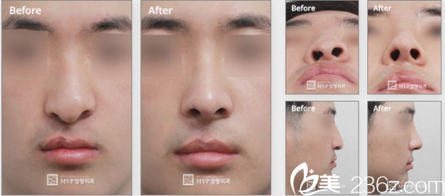 韓國MVP整形外科醫(yī)院案例 韓國MVP整形外科醫(yī)院案例