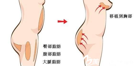 韓國PROPOSE整形醫(yī)院自體脂肪隆胸 韓國PROPOSE整形醫(yī)院自體脂肪隆胸