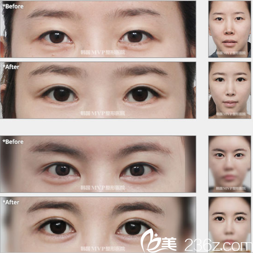 韓國MVP整形外科醫(yī)院案例 韓國MVP整形外科醫(yī)院案例
